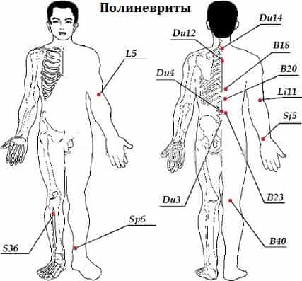 Полиневриты