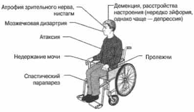 Симптомы рассеянного склероза