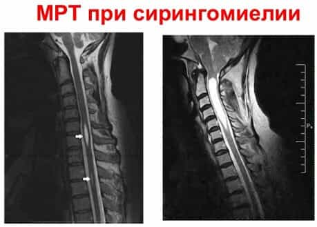 МРТ спинного мозга