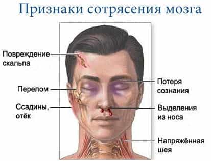 Признаки сотрясения мозга