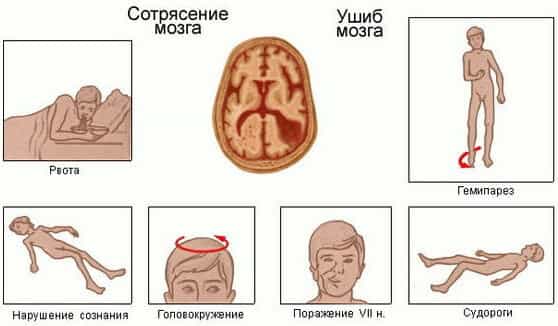 Травмы головного мозга