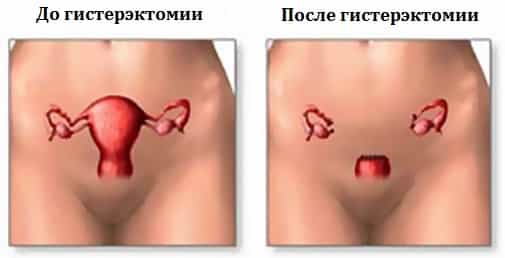 Состояние после гистерэктомии