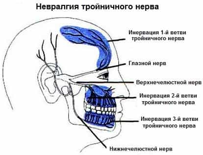 Невралгия тройничного нерва