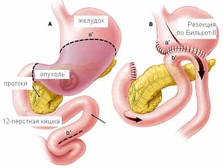 Болезнь оперированного желудка