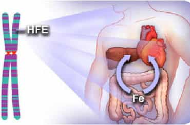 Гемохроматоз
