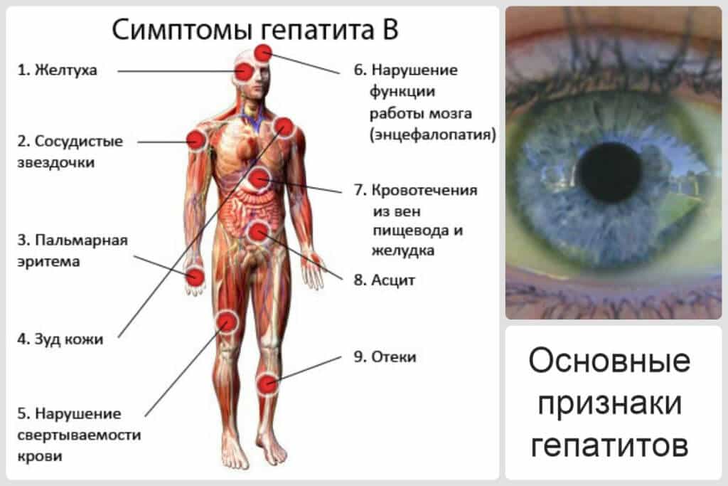 Гепатиты инфекционные. Гепатит B