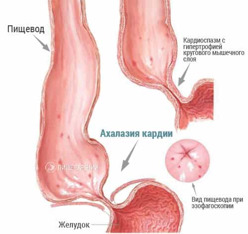 Ахалазия кардии