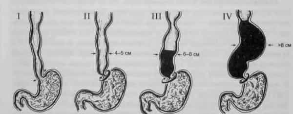 Стадии ахалазии кардии