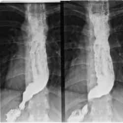 Рентгеновский снимок ахалазии кардии