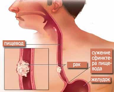 Рак пищевода