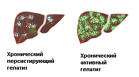 Гепатит хронический