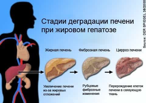 Гепатоз жировой (жировая дистрофия печени)