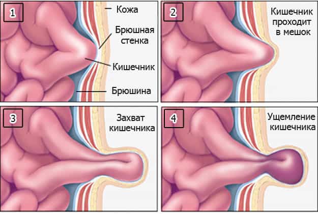 Грыжа