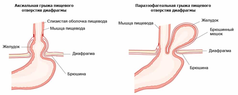 Грыжа пищеводного отверстия диафрагмы