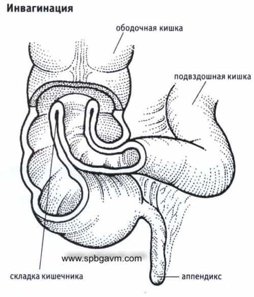 Инвагинация кишечника