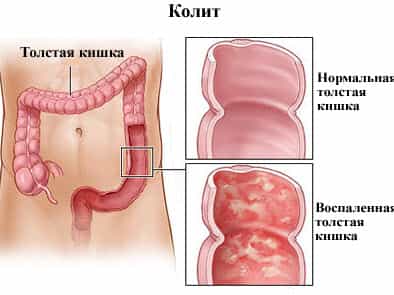 Колит хронический