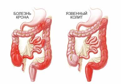 Крона болезнь