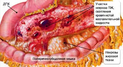 Острый панкреатит