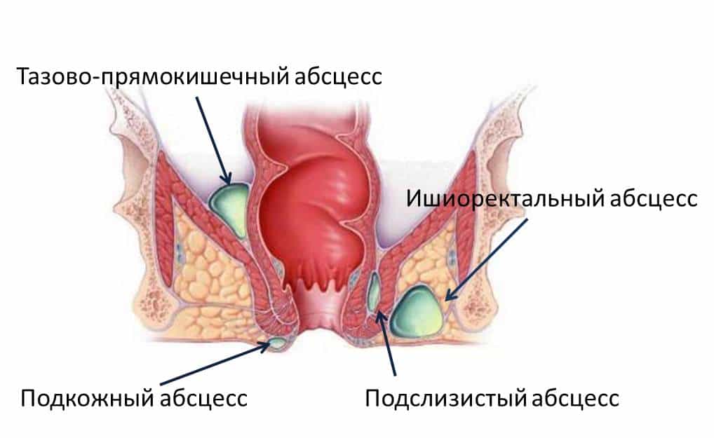 Парапроктит - гнойное воспаление