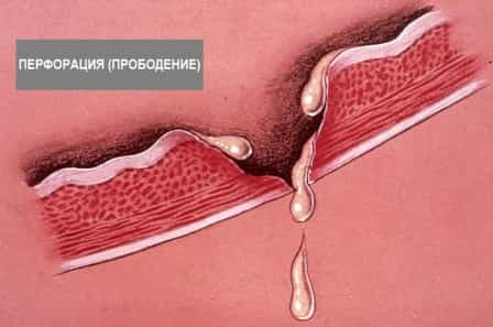 Прободение желудка, двенадцатиперстной кишки, желчного пузыря, кишечника, пищевода