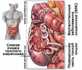 Синдром раздраженной кишки