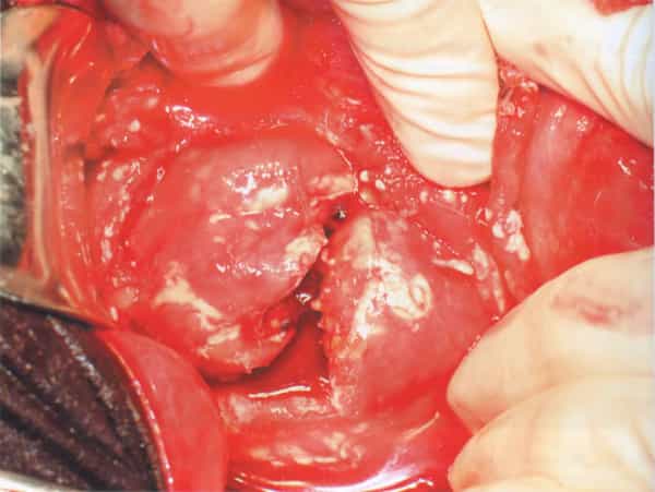 Травма внутренних органов. Поперечный разрыв перешейка поджелудочной железы