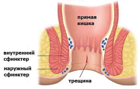 Трещины заднего прохода