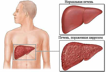 Цирроз печени