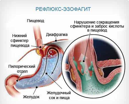 Эзофагит