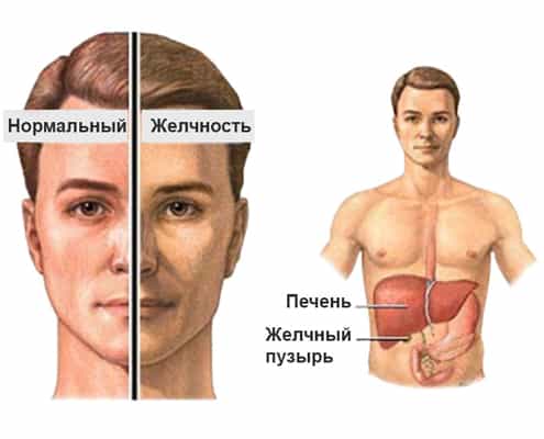 Гепатозы наследственные. Синдром Жильбера