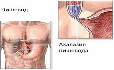 Ахалазия кардии