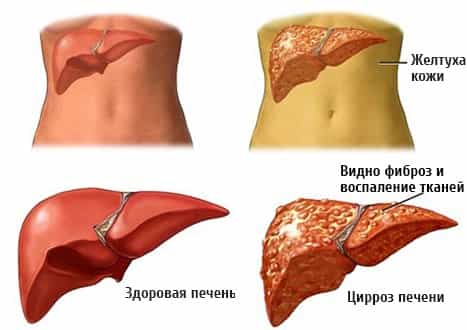 Цирроз печени