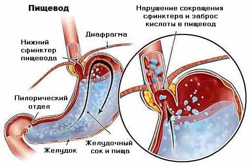 Гастроэзофагеальный рефлюкс