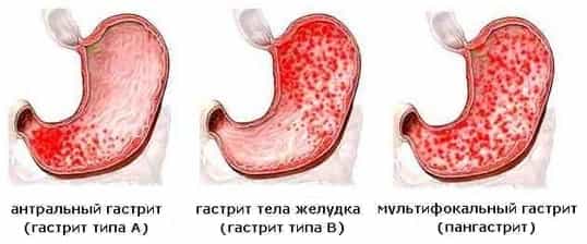 Виды гастрита