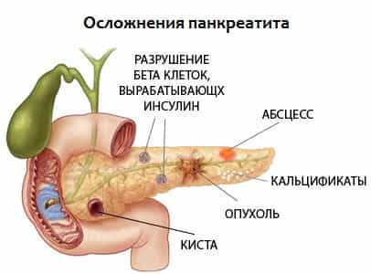 Панкреатит