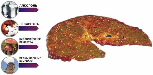 Причины цирроза