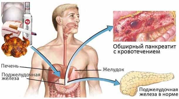 Хронический панкреатит