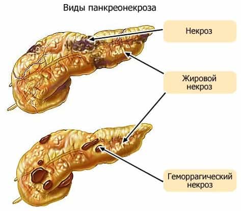 Панкреонекроз