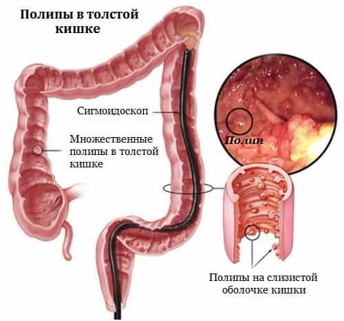 Полипы в кишечнике