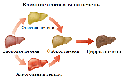 Алкогольный цирроз