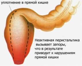 Уплотнение в прямой кишке