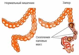 Психогенный запор