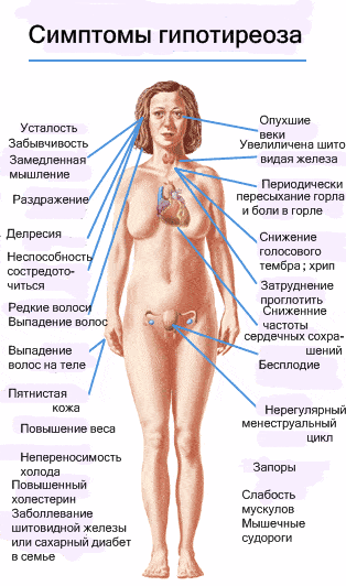 Гипотиреоз щитовидной железы