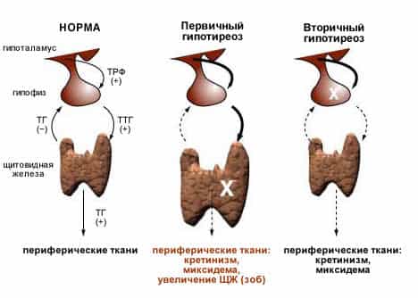 Гипотиреоз щитовидной железы