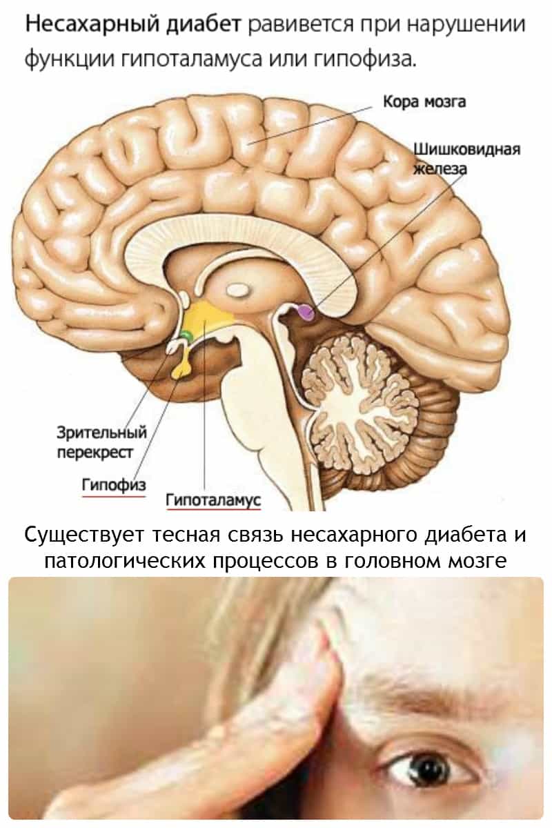 Несахарный диабет. Поражение гипофиза и гипотоламуса.