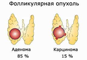 Токсическая аденома щитовидной железы