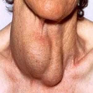 Киста щитовидной железы