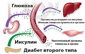 Сахарный диабет 2 типа