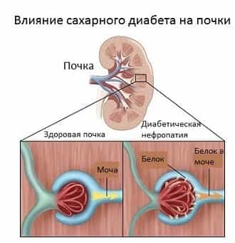 Влияние сахарного диабета на почки