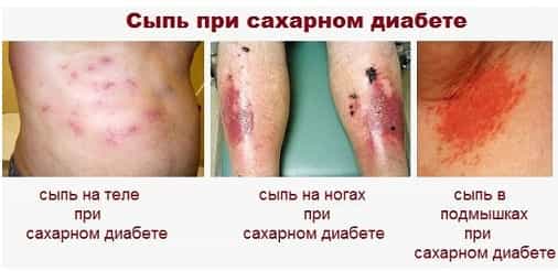 Сыпь при сахарном диабете